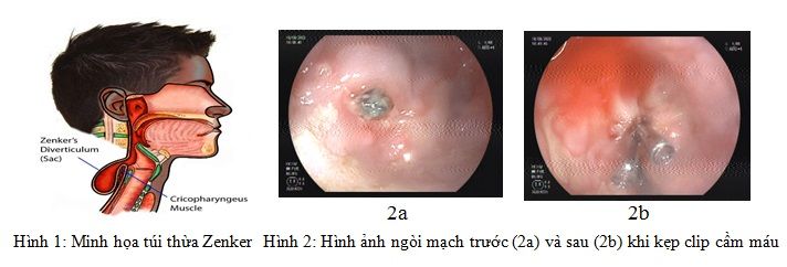 Bệnh viện Nhân Dân 115:Can thiệp cầm máu qua nội soi thành công một trường hợp hiếm gặp