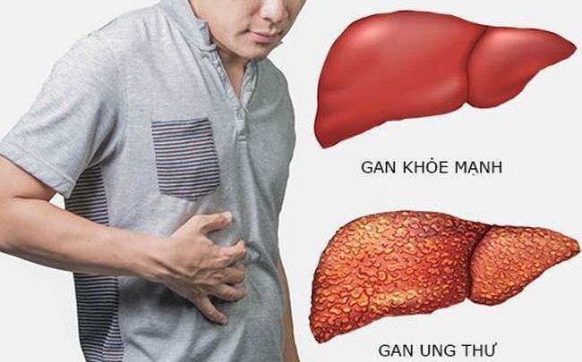 Việt Nam ghi nhận hơn 26.000 trường hợp ung thư gan mỗi năm