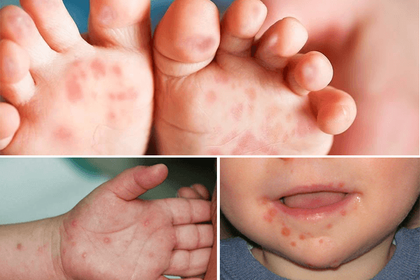 Số ca mắc tay chân miệng ở trẻ em gia tăng