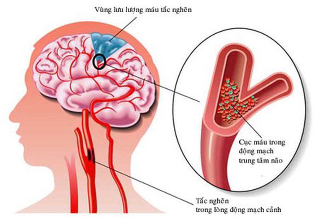 Các biện pháp phòng ngừa đột quỵ khi trời lạnh