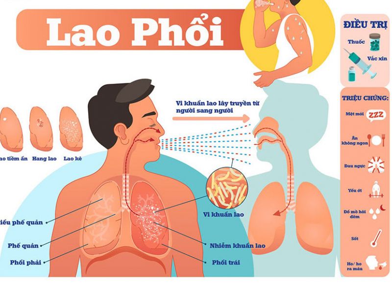 Tăng cường công tác phòng, chống bệnh Lao